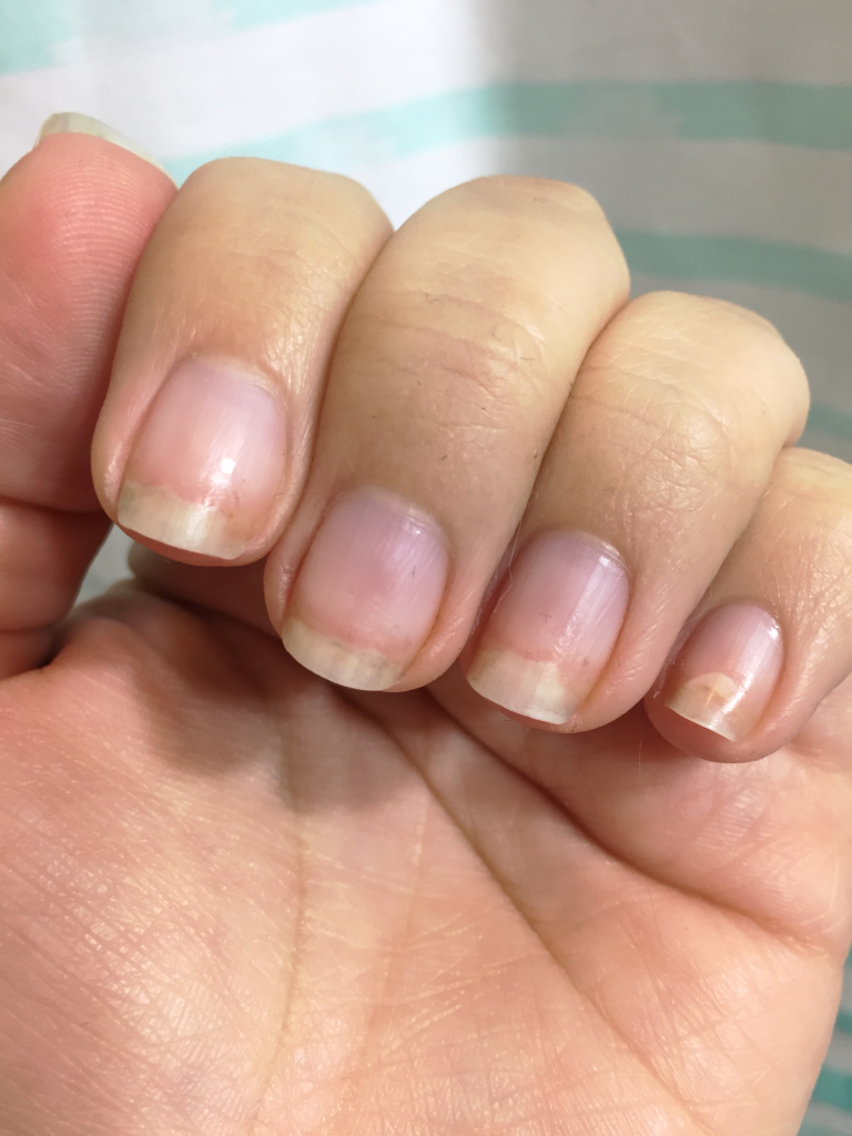 How To Fix Your Fingernails - White Spots, Thickened Nails and More – Buff  Wand